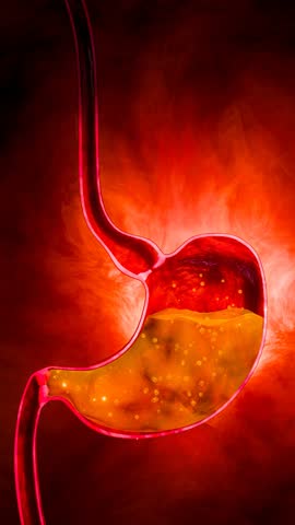 Peptic ulcer and stomach irritation portrayed with realistic belly pain, acid problem, and digestive disorder challenges inside the digestive organ in detailed 3D Rendering.

