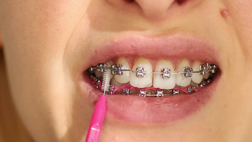 Close up of woman with brackets braces cleaning teeth with orthodontic toothbrushes. Dental care during orthodontic treatment, oral hygiene and health.