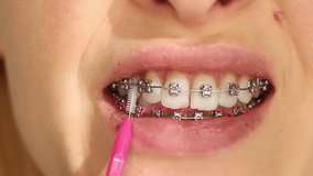 Close up of woman with brackets braces cleaning teeth with orthodontic toothbrushes. Dental care during orthodontic treatment, oral hygiene and health. - Powered by Shutterstock - Get 15% off with code: PIKWIZARD15