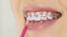 Close up of woman with brackets braces cleaning teeth with orthodontic toothbrushes. Dental care during orthodontic treatment, oral hygiene and health. - Powered by Shutterstock - Get 15% off with code: PIKWIZARD15