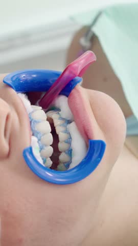 Woman undergoing professional teeth whitening procedure at dental clinic, close up