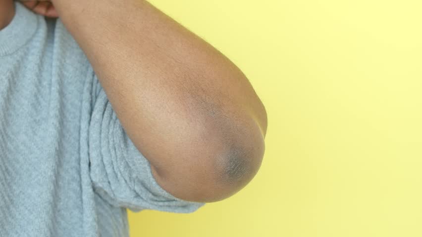 Applying ointment for dry skin on elbow