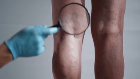 Doctor Inspecting Varicose Veins with Magnifying Glass - Powered by Shutterstock - Get 15% off with code: PIKWIZARD15