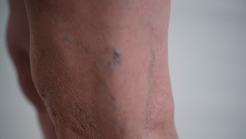 Swollen Varicose Veins on Female Legs