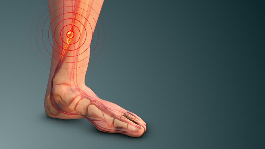 Deep Vein Thrombosis Affecting Leg Circulation