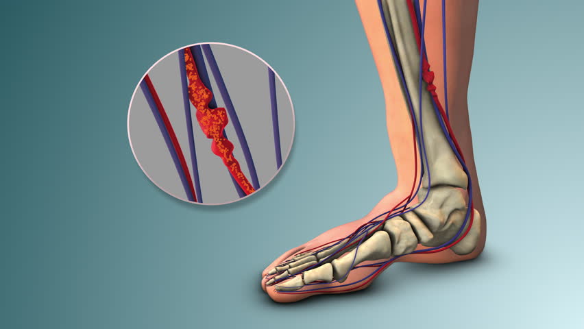 Leg Vein Blockage Due to Deep Thrombosis