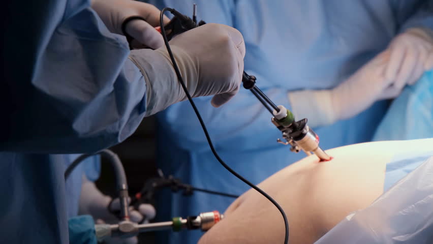 Professional medical team performing minimally invasive laparoscopic surgery using specialized instruments and advanced technology in modern operating room