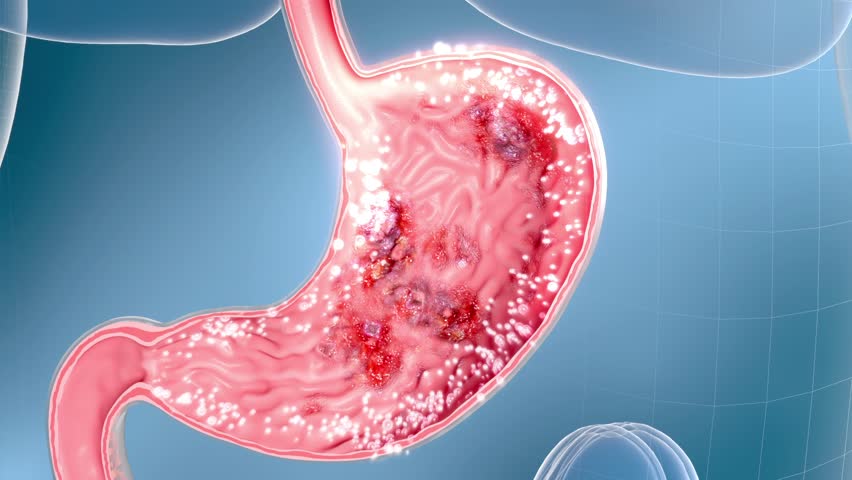 Treat gastritis, gastric disease, gastric ulcer, stomach medicine or gastrointestinal probiotics to promote gastric motility, restore gastric power, digestive system ulcer solution,3d animation.