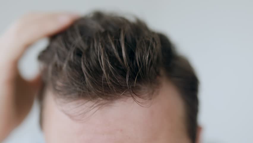 A man carefully touches his hairline with his fingers, checking for signs of hair thinning or hair loss. The close-up highlights a concern for scalp and hair health.
