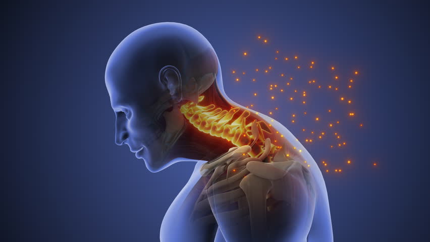 Cervical Posture Syndrome Causing Neck Strain