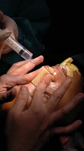 Surgeon performing cosmetic surgery on nose in operating room. Nose reshaping, augmentation. Doctor in gloves holds medical instrument during rhinoplasty.Plastic surgery of the nose in operating  room