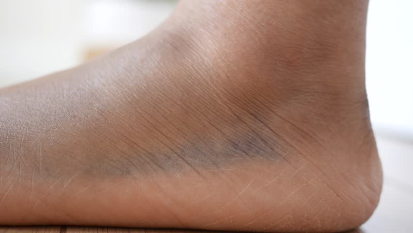 Darkened skin on ankle reveals potential health concerns