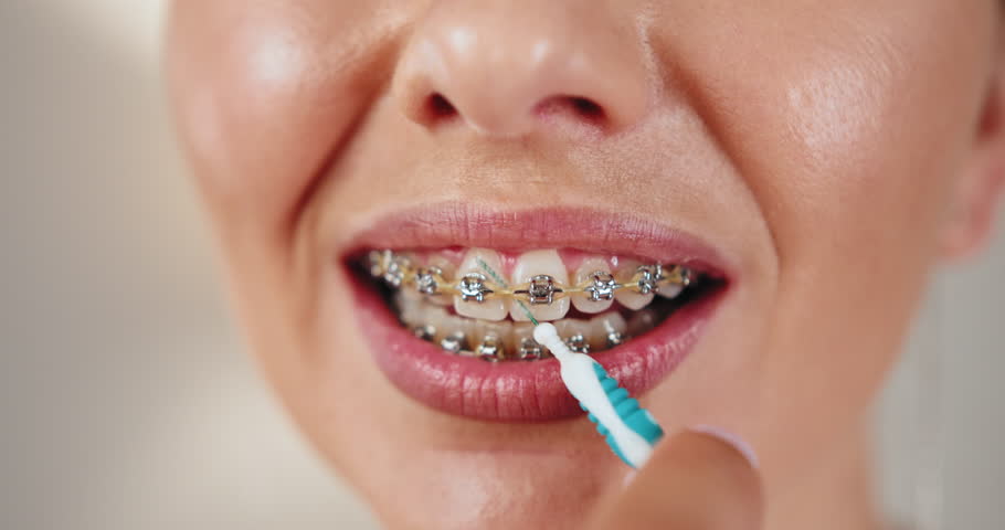 Young Caucasian girl with braces utilizing dental irrigator for oral hygiene and care. Close-up highlights orthodontic maintenance for healthier smile.