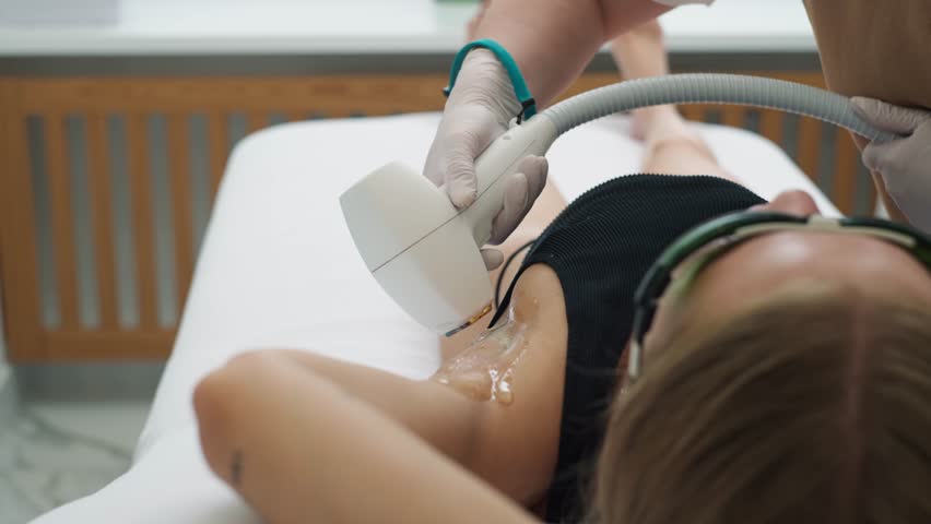 Close-up of laser hair removal on female armpits in a cosmetology clinic. Aesthetic depilation treatment for smooth skin, hygiene, and personal care. High quality 4k footage