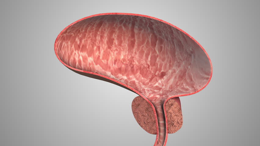 Enlarged Prostate Gland or Benign Prostatic Hyperplasia