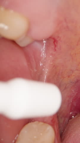 Vertical video. Spray Being Applied into Sore Throat with Redness and Visible Veins on Soft Palate and Uvula, Extreme Macro Close-Up, Medical Treatment Concept