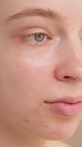 VERTICAL VIDEO: Happy attractive young woman apply facial skincare acne cream, three quarters, apply moisturizer. The concept of skin care advertising, beauty. Close-up of a young girl's face