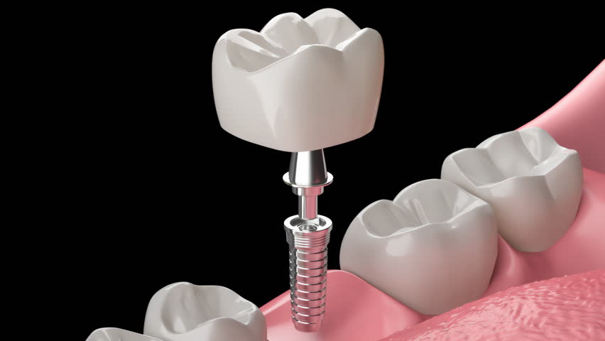 Closeup white tooth and gum with Dental implant , Human Teeth for Medical Concept, 3d Animation.