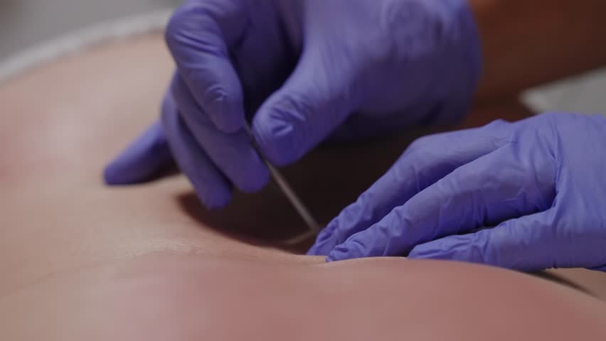 Close up of gloved hands applying acupuncture needle for muscle relief therapy