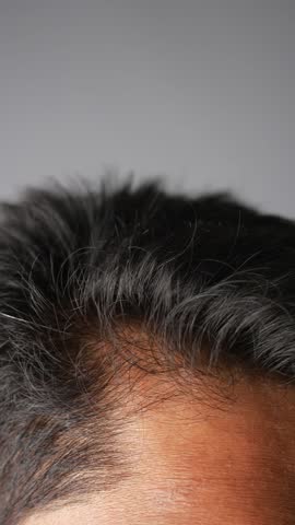 man's head with curly black hair and potential hair loss