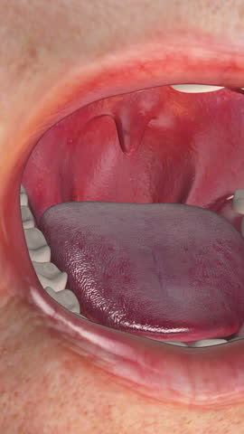Close-Up of Fungal Infection on Human Tongue