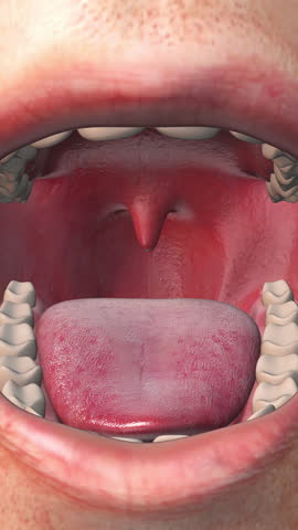 Close-up of a swollen uvula inside a human mouth