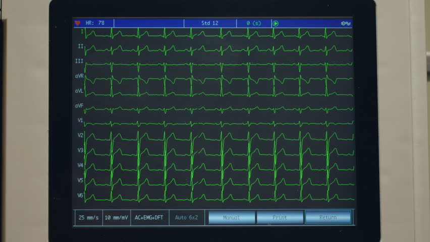 Close-up of EKG monitor displaying heart rate.
