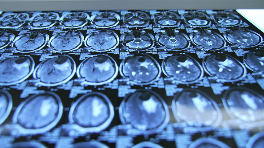Patient's MRI scans in diverse aspects. Neurology and neurosurgery. Preparation for brain surgery. Close up.