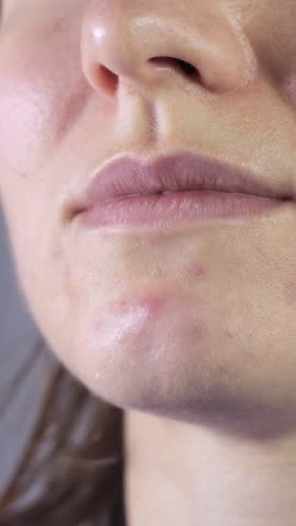 Vertical video of woman applying anti acne master pimple patch with hydrocolloid dressing. Close up, 4k footage.