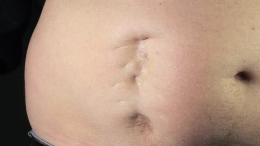 Ugly bad an indented scar on the man's fat belly after the appendicitis surgery. Old keloid scar on the stomach. Medical treatment disease, 4k footage.