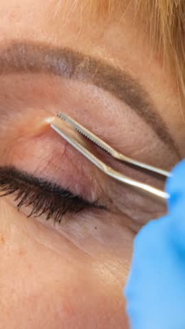 A specialized eye lift procedure that demonstrates the use of plastic surgery