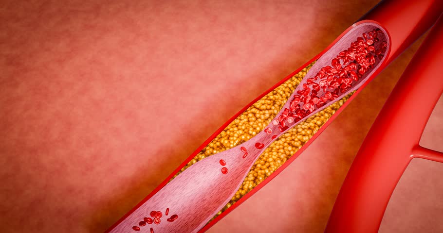 Artery narrowing due to cholesterol deposits, fast food intake, high-sugar beverages, alcohol addiction, processed foods, emphasizing risks hypertension, stroke, cardiovascular death. 3D rendering
