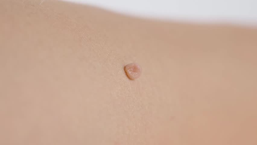 Skin tag or acrochordon or soft fibrom dermatology problem on skin concept.	
