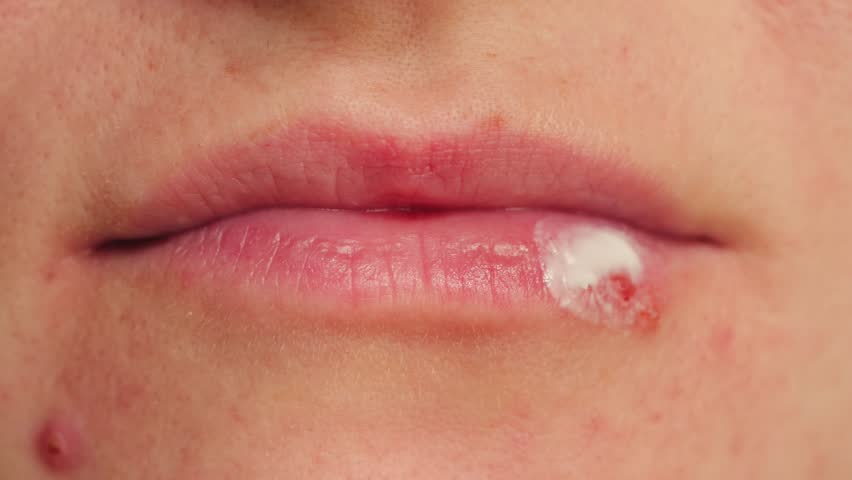 Close-up of lips with ointment applied to herpes sores. Treating herpes on the lips. High quality 4k footage