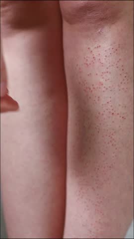 Detailed shot of a woman's hand gently touching a reddened, bumpy leg area post-electrolysis. Hair follicles and skin irritation are visible.