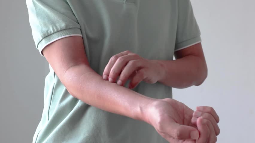 Young asian man itching and scratching on arm from allergic itchy dry skin eczema dermatitis insect bites