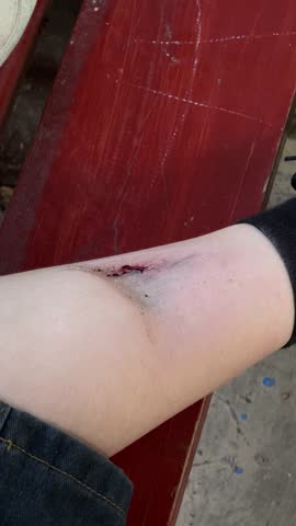 Child's leg injury after swing accident with bruises and scratches, trauma from playtime incident