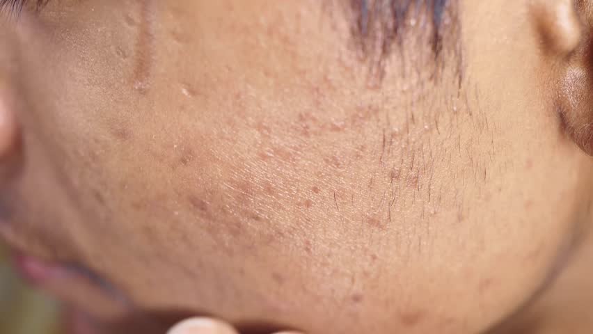 Acne scars and marks on face