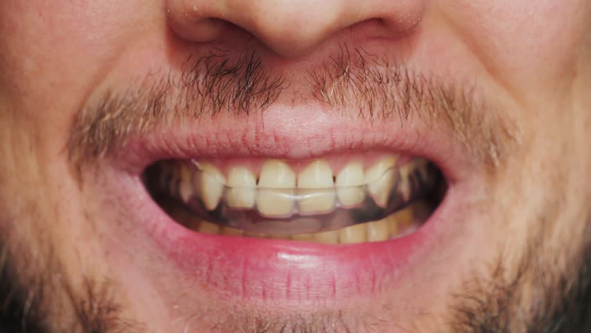 Man putting on a mouthguard, close-up. Dental trainer for adults for the treatment of bruxism. High quality 4k footage