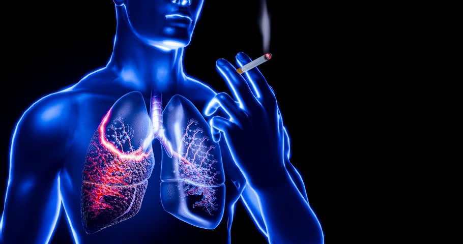 Human lung damage depicted by a cigarette embedded into diseased lungs, showing how smoking leads to cancer, emphysema, COPD, respiratory failure, conditions linked to tobacco abus.3D model.