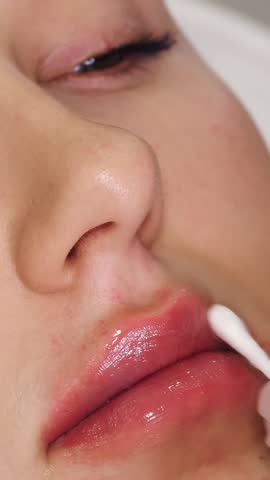 Close-up, female lips. Hand, in medical glove, applies soothing lip balm to the lips with a cotton swab after lip augmentation procedure with hyaluronic acid injections.