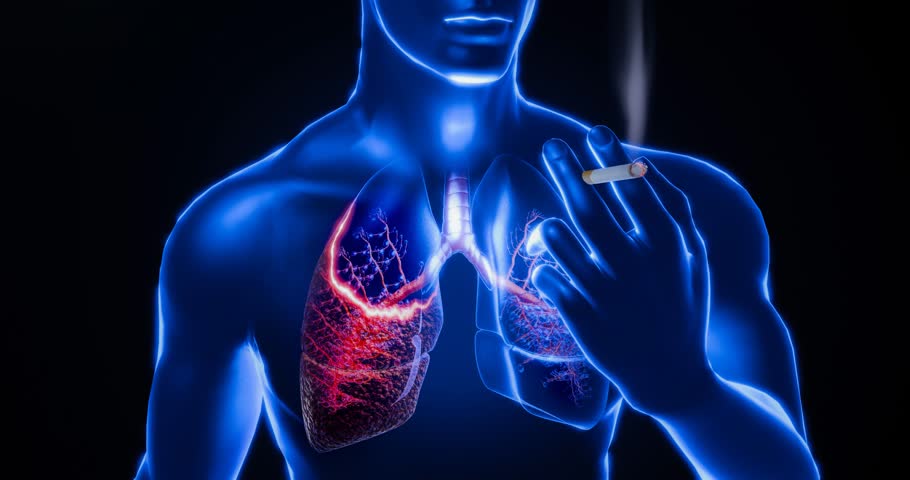 Smoking effects on lungs visualized, showing severe lung disease, tar deposits, cancerous growths, emphysema, and irreversible respiratory system damage due to prolonged cigarette use. 3D rendering