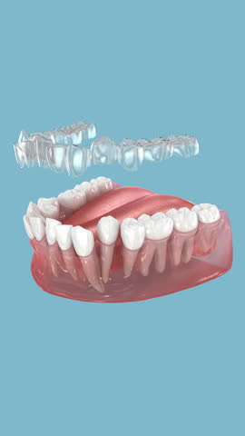 Invisalign braces or invisible retainer make bite correction. 3D animation