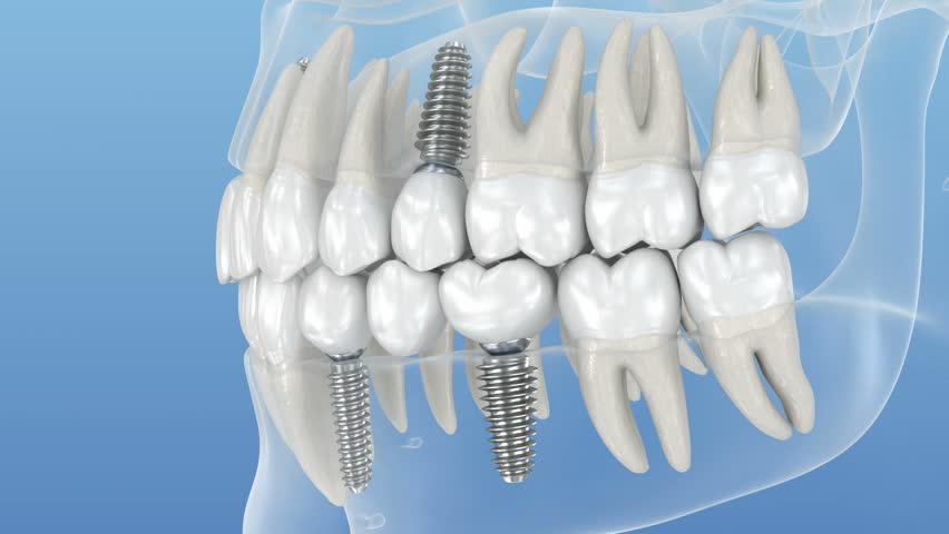 Teeth recovery with dental implant, transparent view. Medically accurate 3D Animation