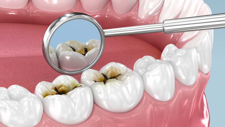 Molar teeth damaged by caries. Medically 3D Animation