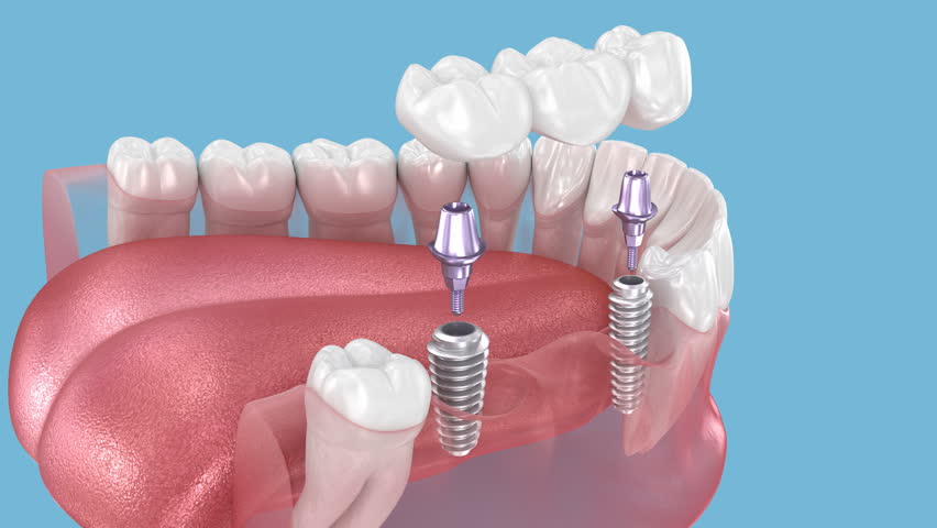 Dental bridge based on two implants. Medically accurate 3D Animation of human teeth and dentures concept