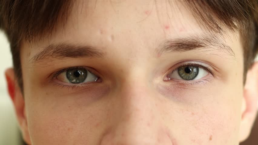 Blue eyes of teenager boy 15-17 years is looking at camera extreme close up. Cropped view of half portrait of caucasian young guy with acne on face blinking. Confident generation z. Problem teen skin