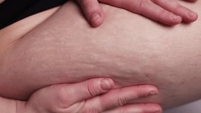 Woman compressing the skin on her legs checking for cellulite and excess subcutaneous fat. A woman showing her stretch marks on her hips. Female thighs with stretch marks on the skin. - Powered by Shutterstock - Get 15% off with code: PIKWIZARD15