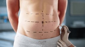 Man Aesthetic Plastic Surgery In Hospital. Tummy Abdomen Marks - Powered by Shutterstock - Get 15% off with code: PIKWIZARD15