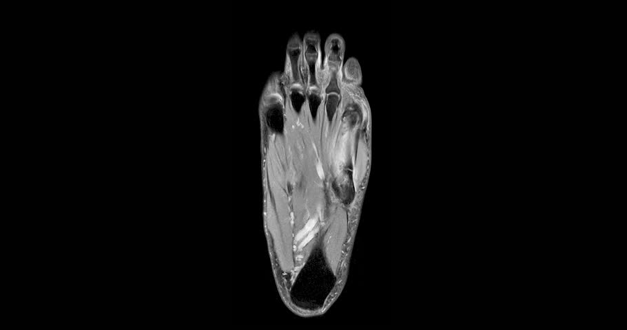 MRI foot scan for a diagnostic of the foot and ankle following symptoms: pain  both feet, swelling, redness or warmth, numbness or tingling and stiffness.